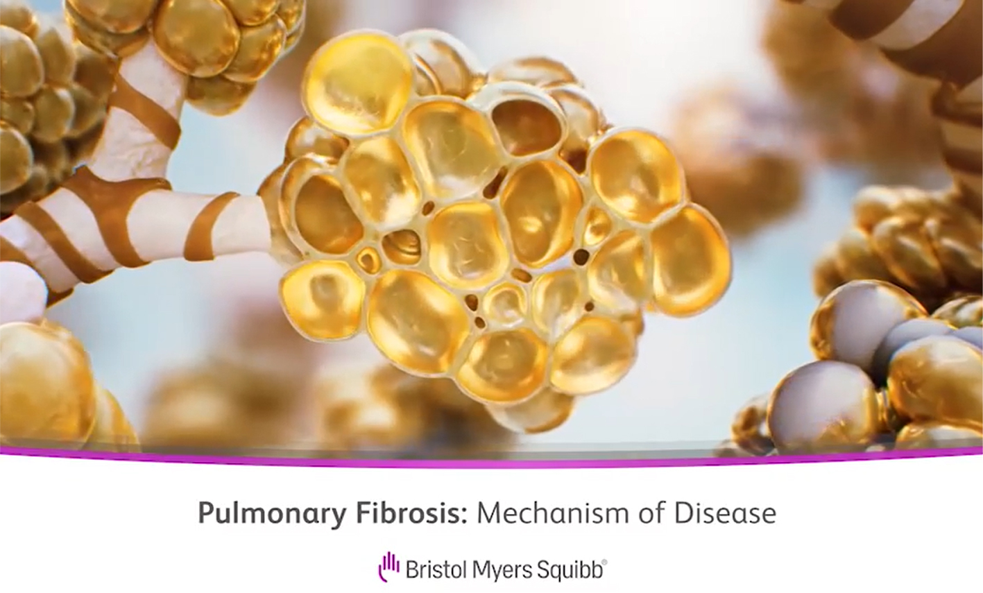 Video Link: Pulmonary Fibrosis: Mechanism of Disease